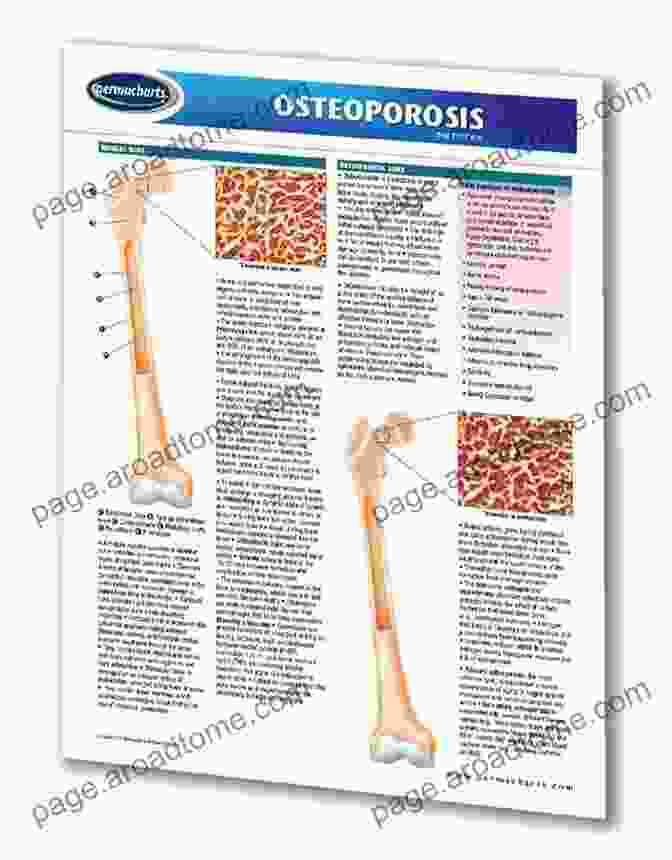 Osteoporosis Chart Quick Reference Guide Book Cover Osteoporosis E Chart: Quick Reference Guide