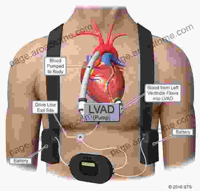 Surgeon Implanting A Left Ventricular Assist Device The Matter Of The Heart: A History Of The Heart In Eleven Operations