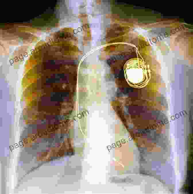 Surgeon Implanting An Implantable Cardioverter Defibrillator The Matter Of The Heart: A History Of The Heart In Eleven Operations