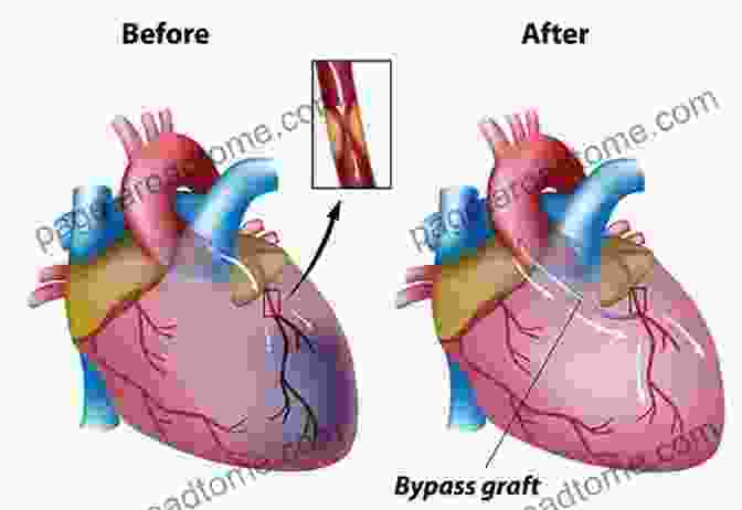 Surgeon Performing A Coronary Artery Bypass Graft Surgery The Matter Of The Heart: A History Of The Heart In Eleven Operations