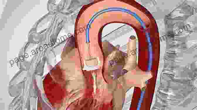 Surgeon Performing A Transcatheter Aortic Valve Replacement Procedure The Matter Of The Heart: A History Of The Heart In Eleven Operations