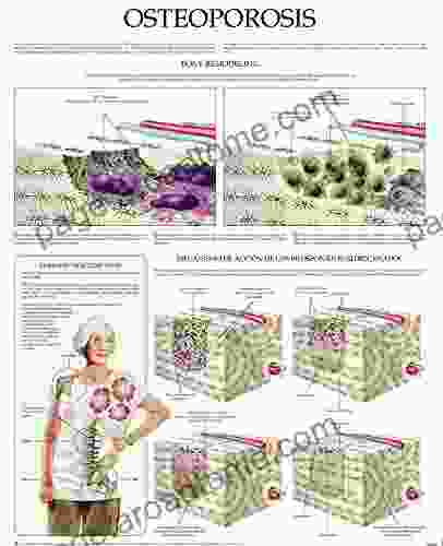 Osteoporosis E Chart: Quick Reference Guide